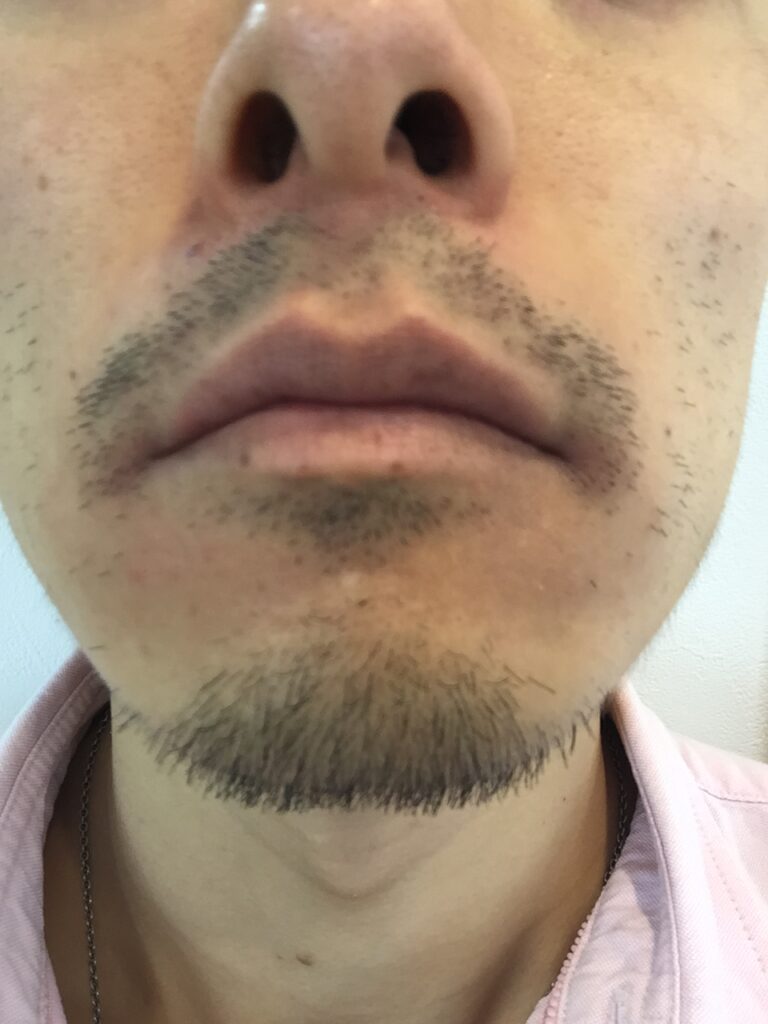脱毛,ビフォー画像